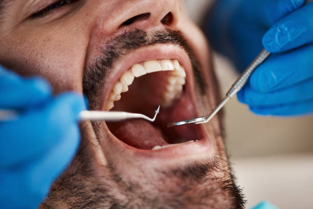 Best Chipped Tooth Repair Near Me  in Fairfax, OK